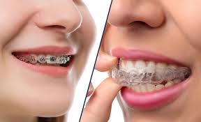 Invisalign vs Traditional Braces